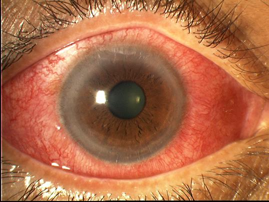 Eyevision Diseases And Disorders Pictures